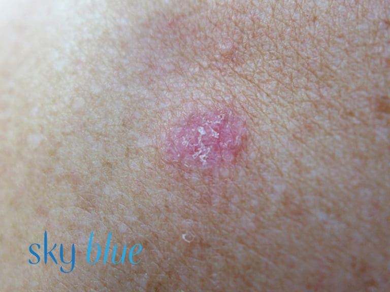 Superficial BCC 1b (close up) - Sky Blue Dermatology